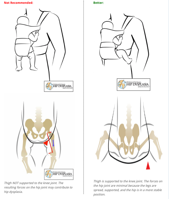 baby carriers and hip dysplasia